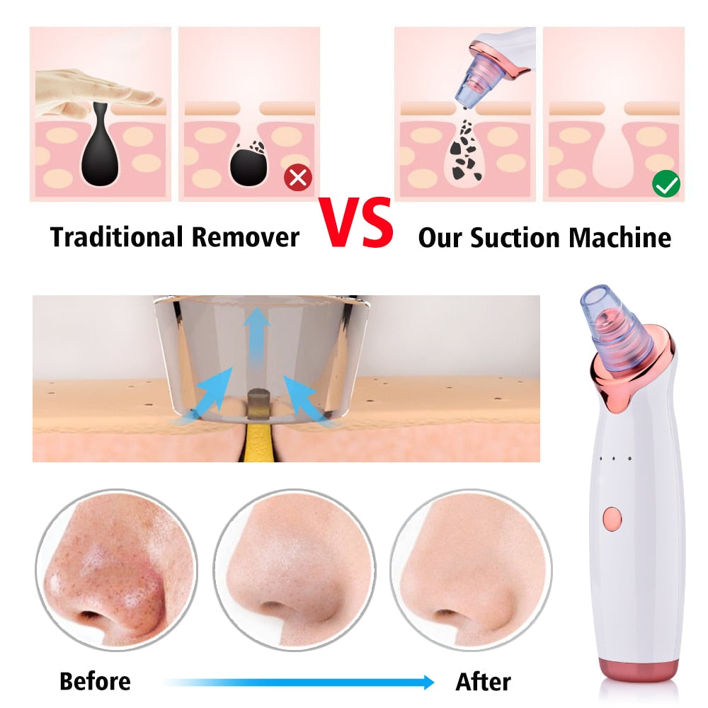 Blackhead Suction Electric Instrument